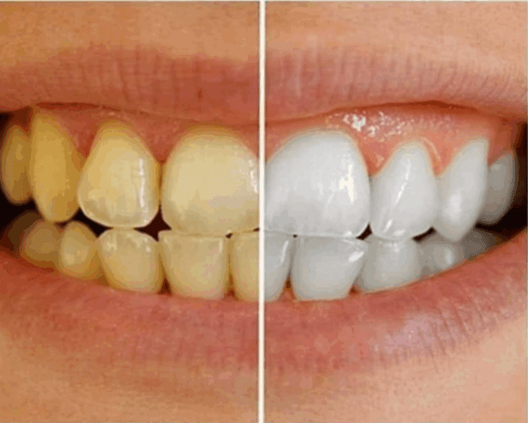 Sbiancamento dei denti: 7 metodi comprovati per eliminare definitivamente l’ingiallimento dei denti!