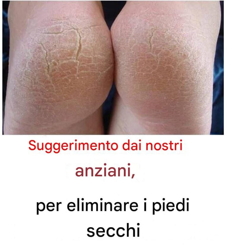 Sbarazzati dei piedi secchi con questa semplice ricetta