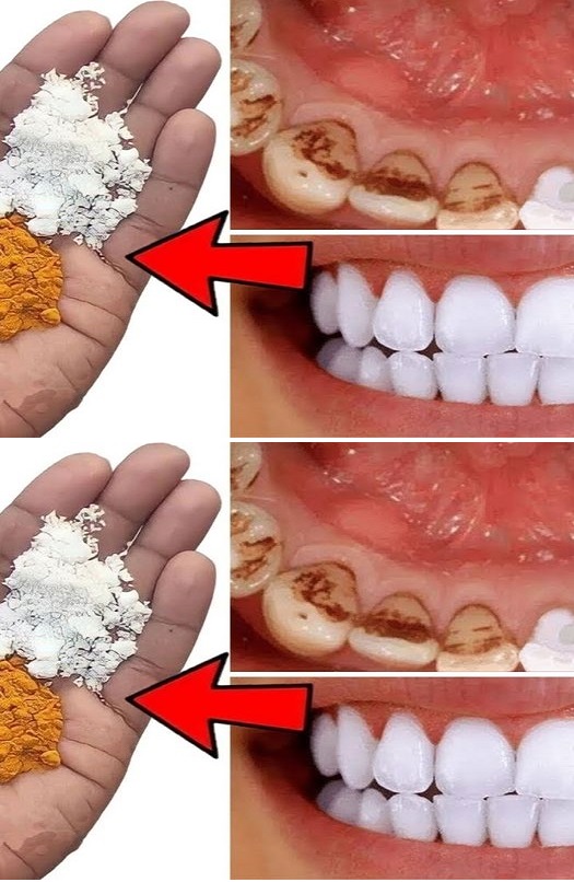 Illumina il tuo sorriso: un metodo rapido per sbiancare i denti a casa