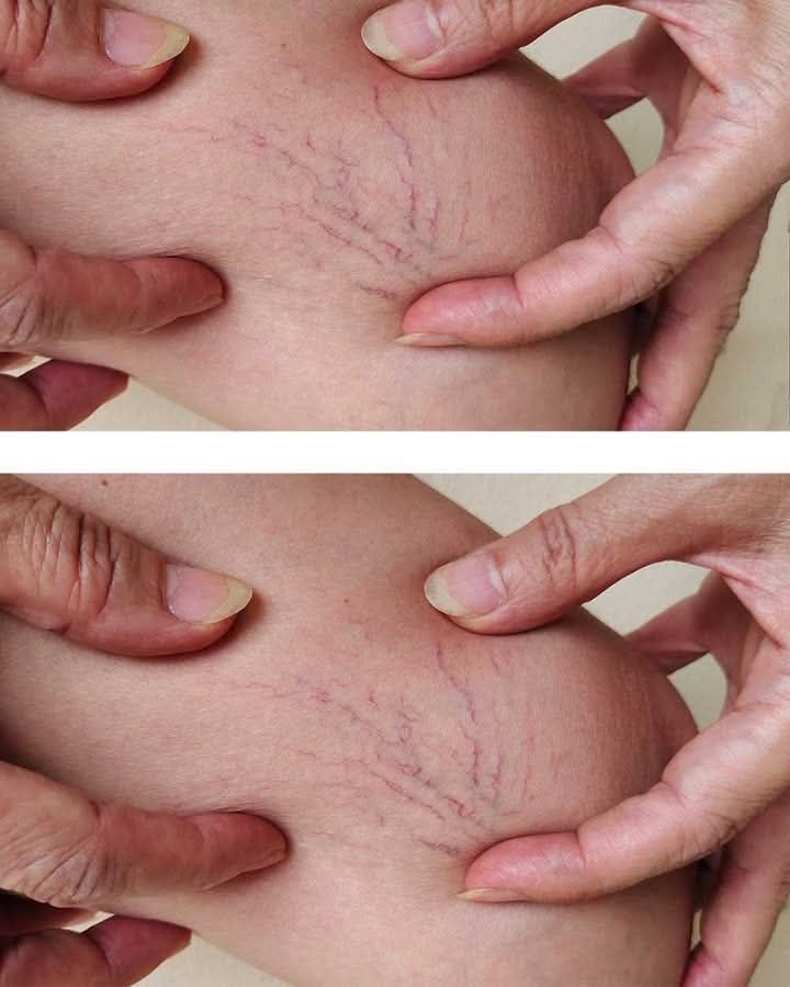 Vene rosse che si diffondono sulle cosce: cosa possono significare