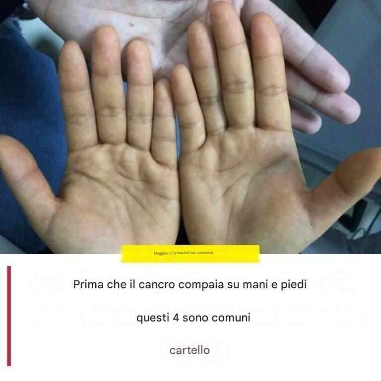 Segnali importanti sulla pelle di mani e piedi che meritano attenzione
