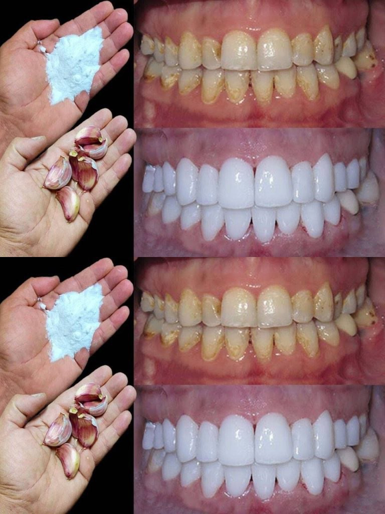 Come sbiancare i denti in 2 minuti